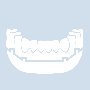 Stegprothese Abbildung einer Stegprothese