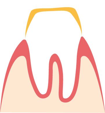 Unverblendete Metall-Kronen sind silbern Bild einer Metall-Krone