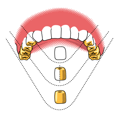 Verblendgrenzen bei der Regelversorgung Illustration der Verblendgrenzen bei der Regelversorgung anhand eines Bildes